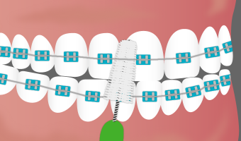 Braces can cause changes in the mouth that can look like gums growing over your braces! Click to learn about gum inflammation and swollen gums with braces.