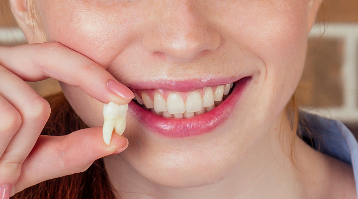 Why Do We Have Wisdom Teeth?