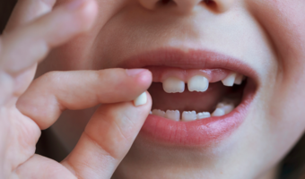 Child holing up their baby tooth.