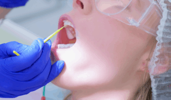 Person at the dentist, getting fluoride applied to their teeth.