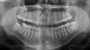 X-ray of a persons mouth.